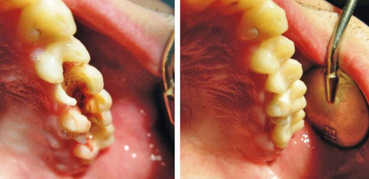 Постановка пломбы после лечения зубов
