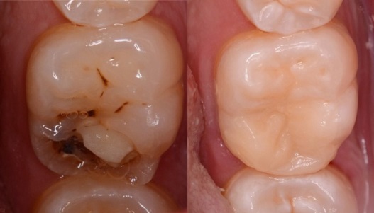 Лечение и пломбирование зуба