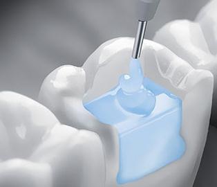 Пломбирование зубов стоматология
