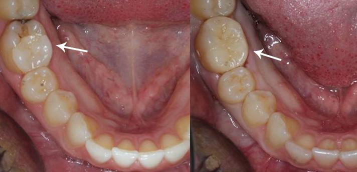 Лечение кариеса зуба жевательной группы