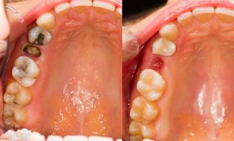 Удаление корня зуба и лечение кариеса