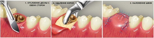 удаление корня стоматологом