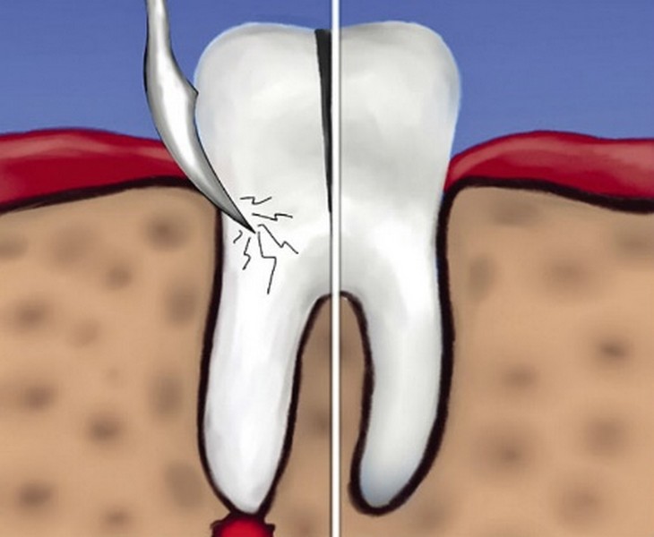 Удаление корня зуба 