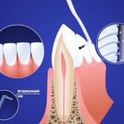 Применение реминерализирующих и фторосодержащих препаратов(1 зуб)