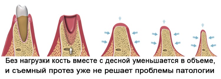 деградация (рассасывание) костной ткани