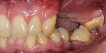 имплантация зуба в москве