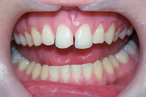 До коррекции формы передних зубов 11 и 21