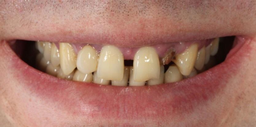 Восстановить утраченную функцию и эстетический вид первого большого коренного зуба на верхней челюсти справа.