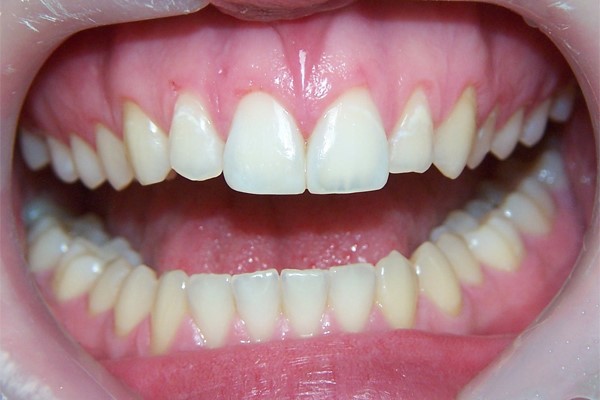 После коррекции формы передних зубов 11 и 21